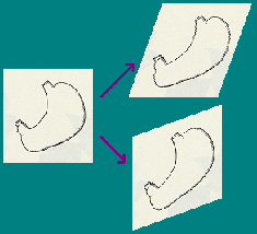 Transformed stomach